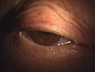 【症例】眼瞼下垂症手術（眼瞼挙筋短縮術）