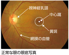 加齢黄斑変性