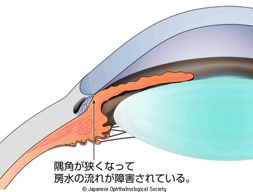 閉塞隅角緑内障