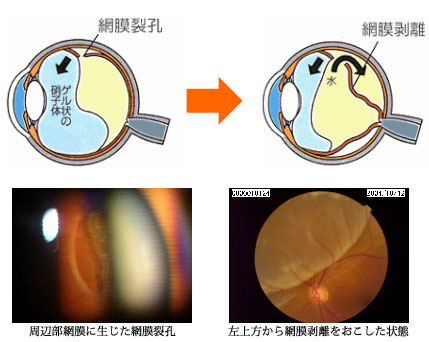 網膜裂孔・網膜剥離