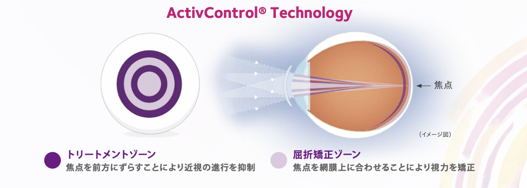 マイサイト®ワンデー（MiSight®１day）