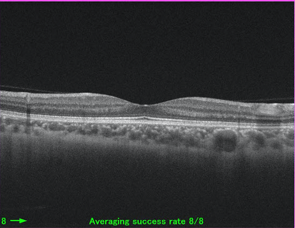 正常な網膜断層写真