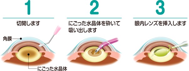 白内障手術の流れ 日帰り白内障手術 治療 手術 医療法人社団 彩光会