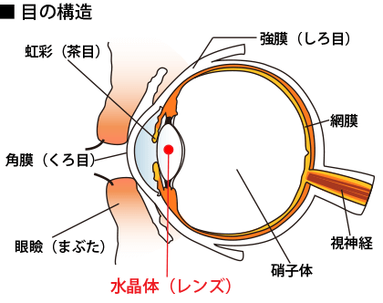 白内障