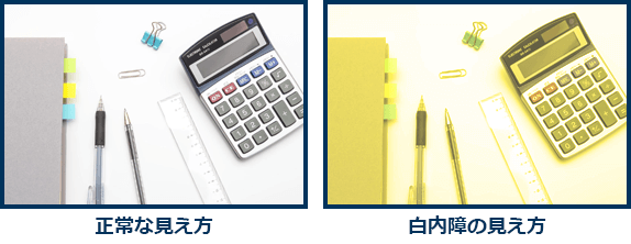白内障