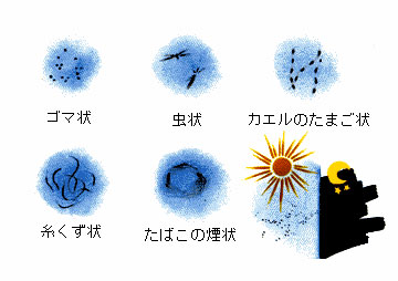 飛蚊症とは？