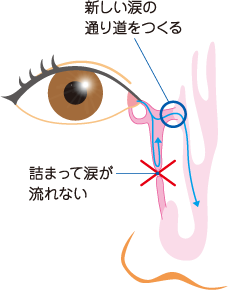 涙嚢鼻腔吻合術 （DCR）