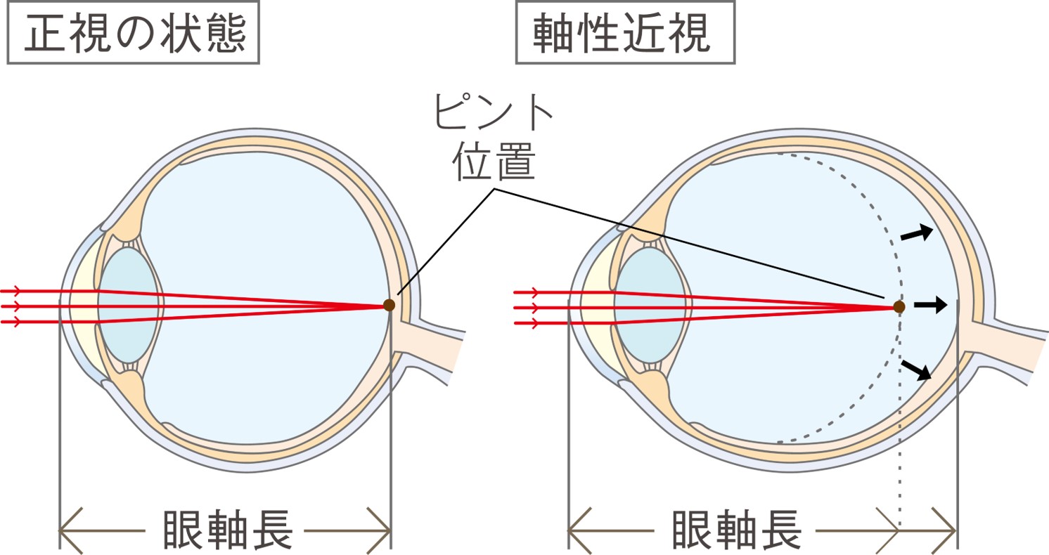 近視の進行と眼軸長の伸展