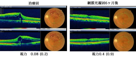 症例１　左眼上方に生じた網膜中心静脈分岐閉鎖症