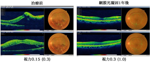 症例２　左眼下方に生じた網膜中心静脈分岐閉鎖症