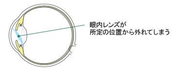 眼内レンズの偏位・脱臼