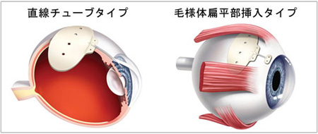 チューブシャント手術