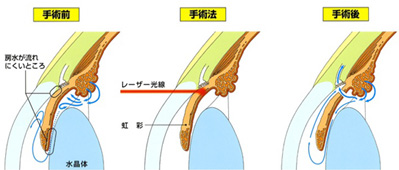 毛様体光凝固術（CYCLO G6）