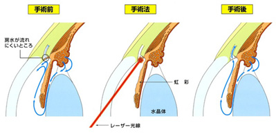 選択的レーザー線維柱帯形成術（SLT）