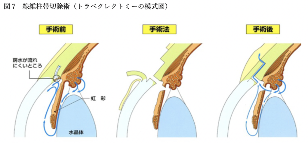 濾過手術（トラベクレクトミー＆インプラント手術）