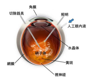 網膜硝子体手術