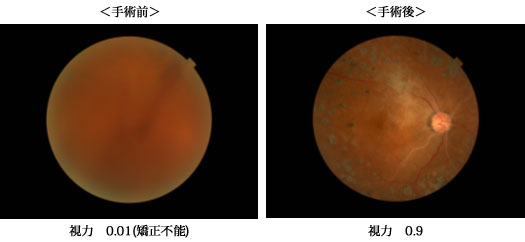 糖尿病性網膜症による硝子体出血