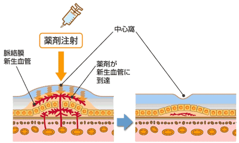 抗VEGF硝子体内注射