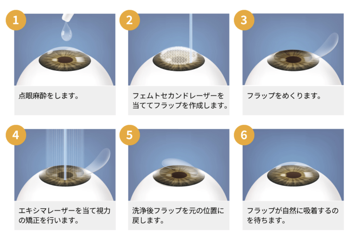 レーシック手術方法の流れ
