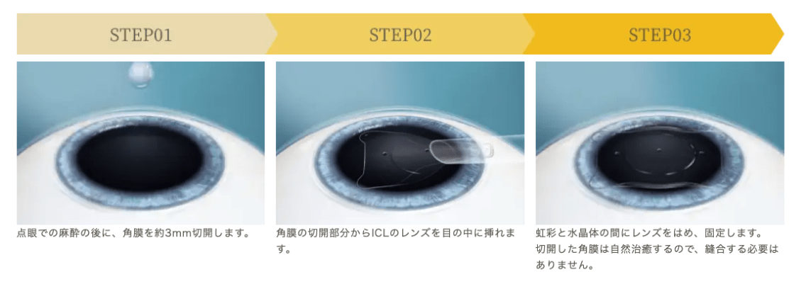 ICL手術方法の流れ